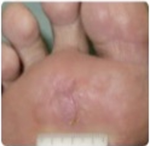 Phase 5 — Near Full Healing: Almost healed. Small faint pink area of new skin visible.