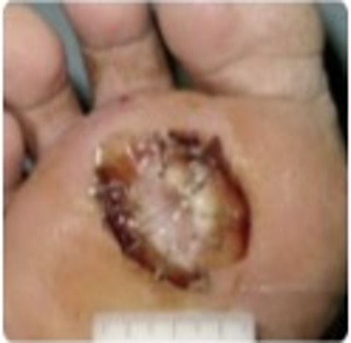 Phase 2 — Debridement: Wound debrided and re-sutured. Cleaner margins, dark crust forming along suture line.