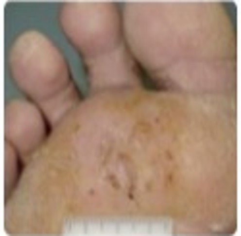 Phase 4 — Wound Cleaning: Crusts less prominent. Surrounding inflammation subsiding.