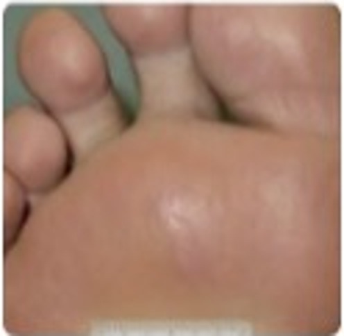 Case 01 — Phase 6, complete recovery of the diabetic foot wound