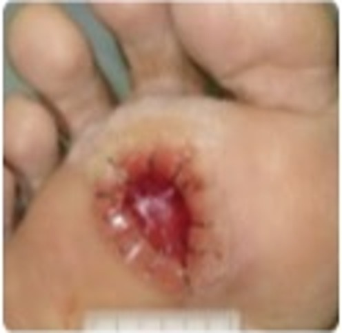 Baseline — Phase 1 (Initial Injury) — Deep laceration (~3–4 cm). Primary sutures placed to close the wound.