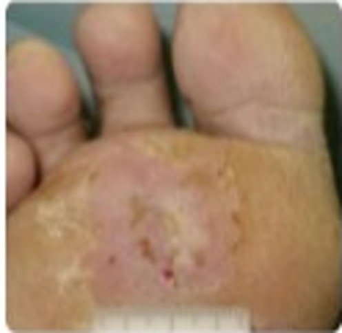 Follow-up — Phase 3 (Suture Removal) — Sutures removed. Shallow abrasion with yellowish crusts and surrounding erythema.